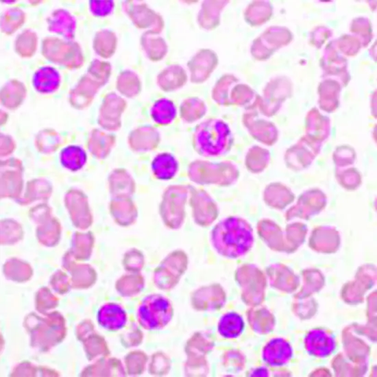 chronic lymphocytic leukaemia cll mutations detection panel 1 test